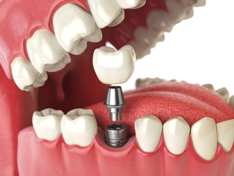 Benefits of Dental Implants: A Solution for Missing Teeth
