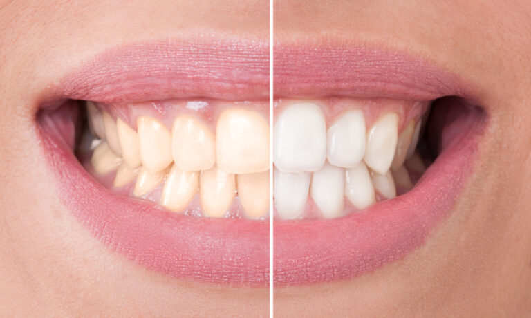 Secrets to a Brighter Smile: Top Teeth Whitening Tips!