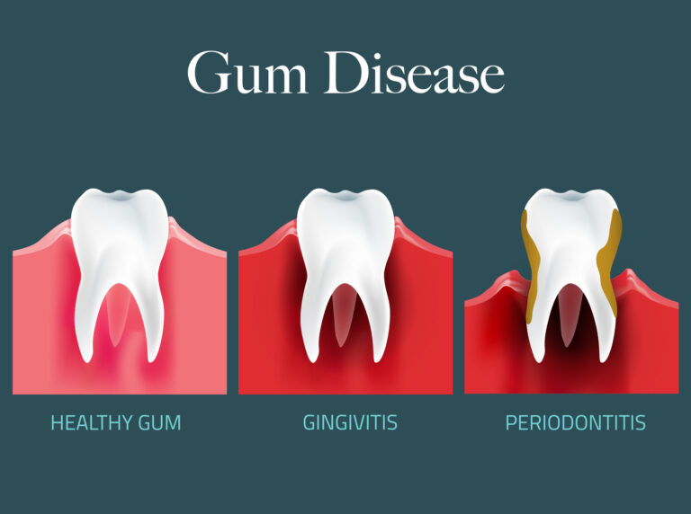 Gum Disease: More Than Just a Dental Problem